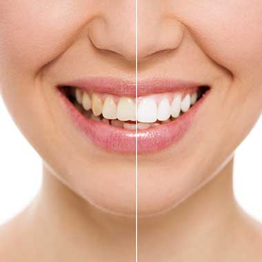 Teeth Whitening in Asheboro
