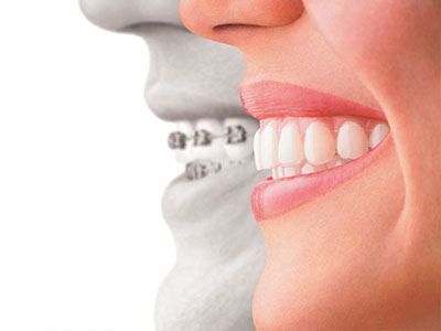 The image shows a split-screen comparison of an individual s face with and without dental implants, emphasizing the transformation in appearance.