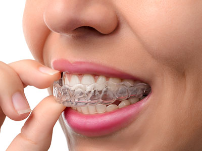 A person with a clear aligner, holding it up to their teeth.