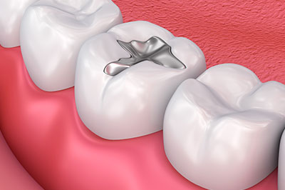 The image displays a close-up view of a dental implant being inserted into a prepared tooth socket within an oral cavity, with the surrounding teeth and gums visible.