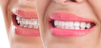 A close-up image of a person s smiling face with an emphasis on teeth, featuring two distinct angles of the same smile.