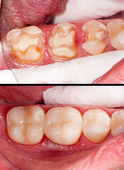 The image shows a close-up of an open mouth with teeth, gums, and tongue visible.