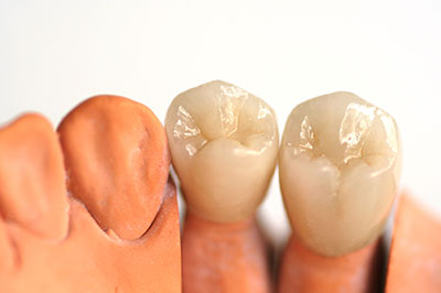 An image depicting a set of dental implants with artificial gums and teeth.