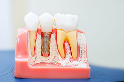 The image shows a model of a human mouth with teeth, gums, and a screw-in implant, simulating a dental implant procedure.