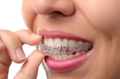 The image shows a person wearing braces, with their fingers holding the brackets in place.