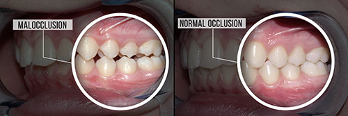 The image shows a side-by-side comparison of two dental procedures, with the left side labeled  Malocclusion  and the right side labeled  Normal Occlusion,  indicating the transformation from misaligned teeth to properly aligned teeth.