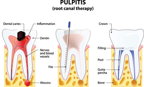 The image is a detailed medical illustration showing the process of pulpitis, specifically focusing on the root canal therapy. It depicts various stages and tools used in this dental procedure, including a tooth with a visible cavity, a drill bit, a file, and a filling material.