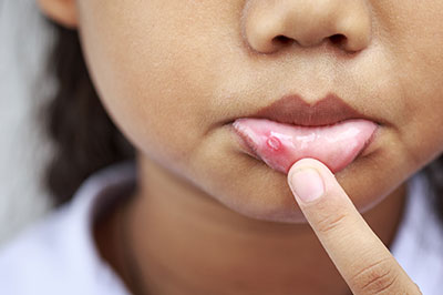 The image shows a close-up of a person s face with a noticeable blemish being pointed out by an index finger.