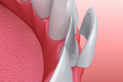 An illustration of a dental implant procedure, showing the surgical placement of an implant into a prepared socket in the jaw.