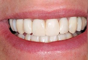 A close-up of a person s teeth with a bright smile, showcasing dental implants.