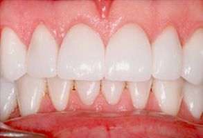 The image shows a close-up of a person s teeth, with the focus on a set of white dental implants that are well maintained and clean.