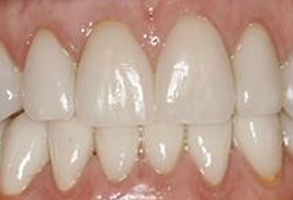 The image shows a close-up of a person s teeth, with the focus on the front teeth.