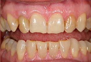 Dental implants with a focus on the upper front teeth, showcasing a transformation from yellowed to white and straight.