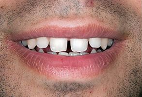 The image shows a close-up of a person s face with a focus on the teeth, which are crooked and have braces. The individual appears to be smiling or laughing, revealing their teeth.