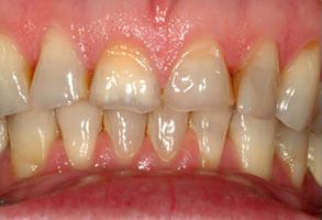 The image shows a close-up of a person s teeth with an upper and lower set, featuring yellow stains and some missing teeth.