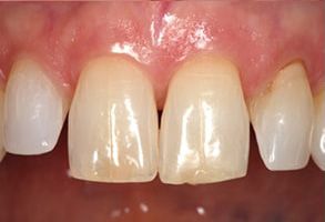An image of a person s teeth with noticeable discoloration, particularly in the front upper teeth.